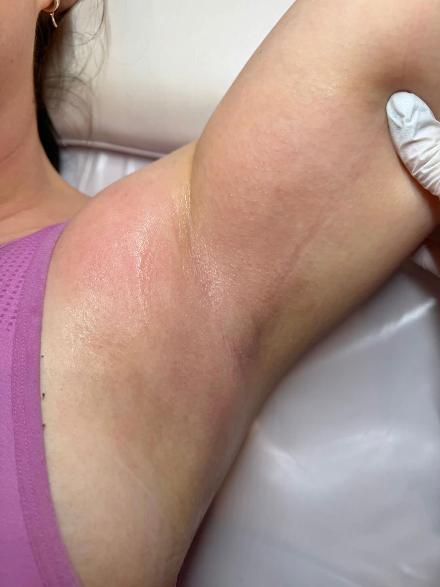 Underarm after laser hair removal treatment