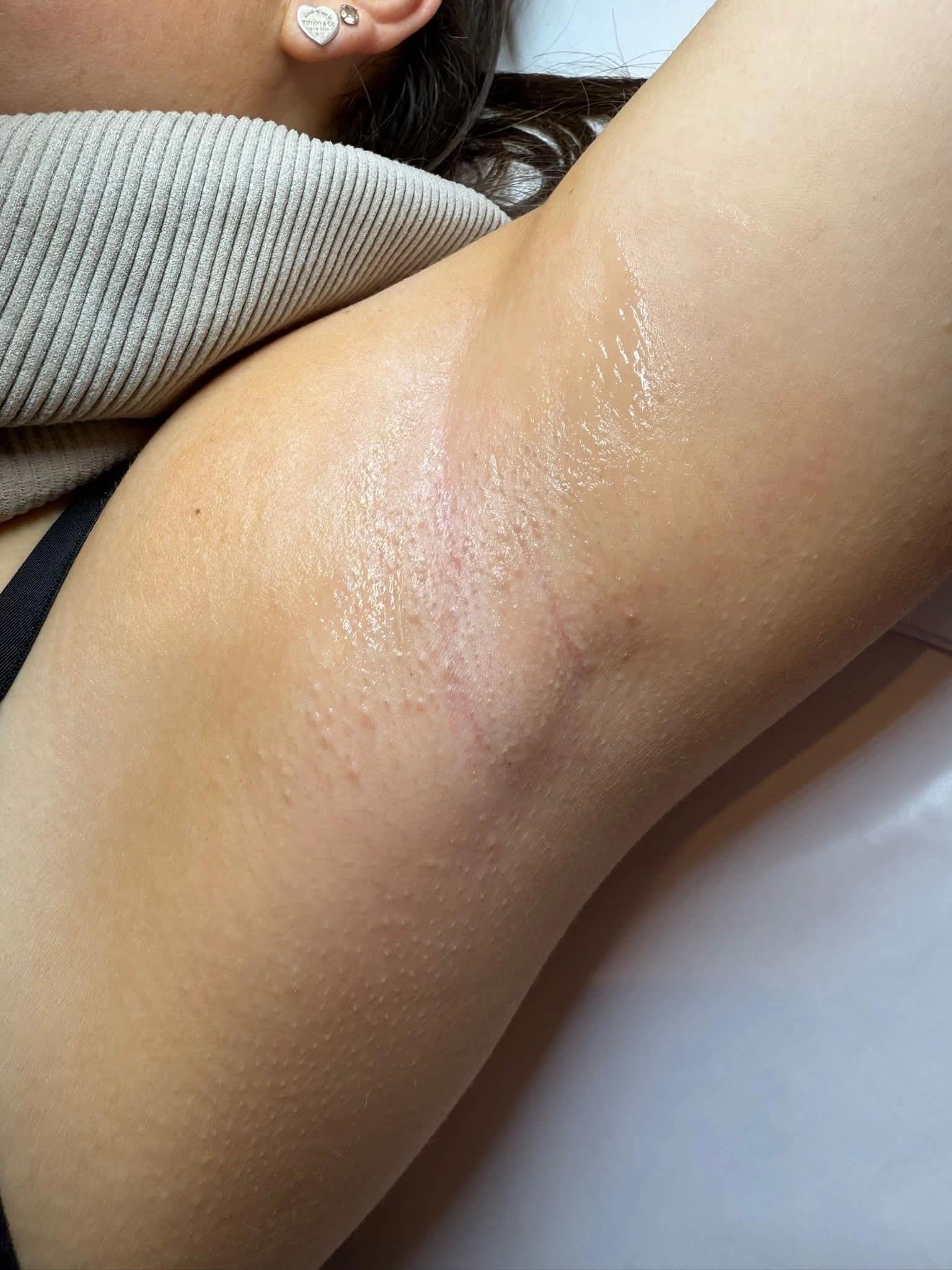 Underarm area after laser hair removal