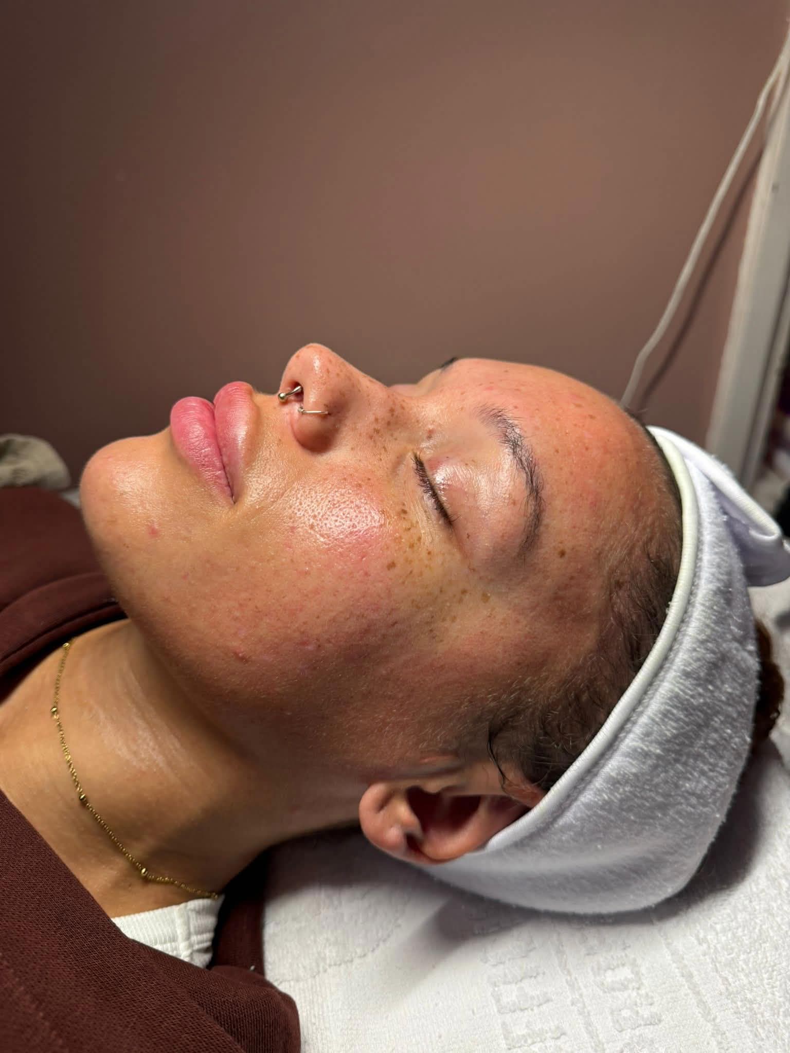 Client skin after facial treatment showing a glowing complexion