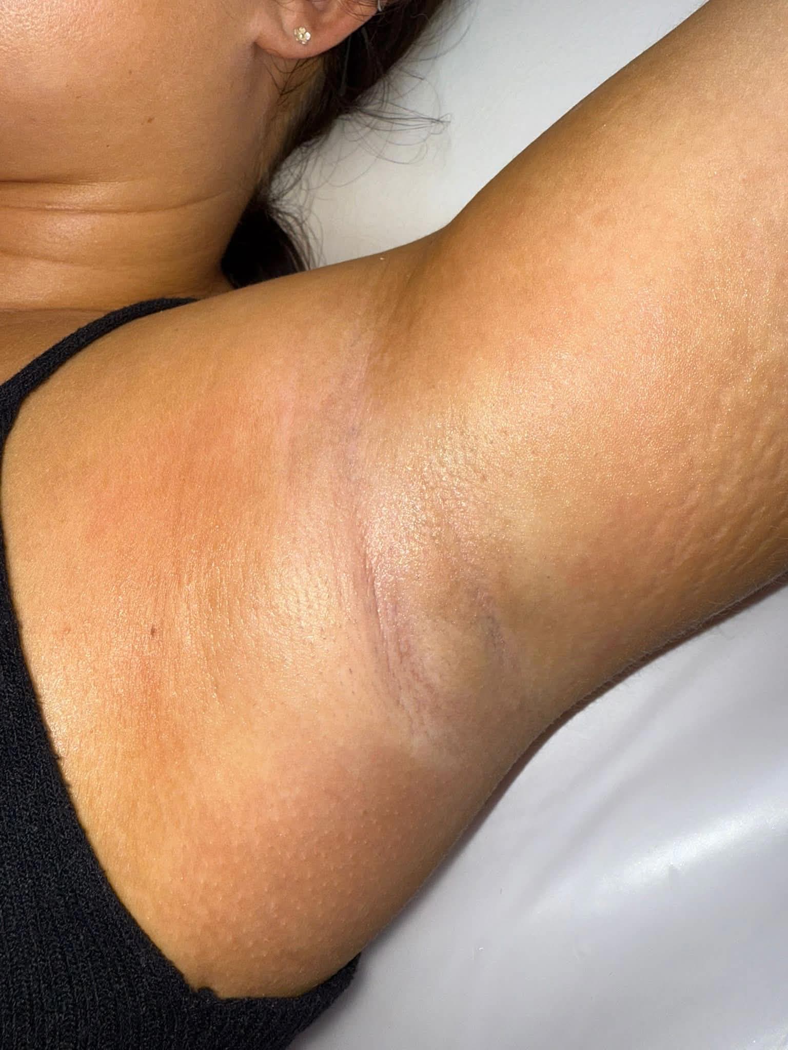 Underarm after laser hair removal treatment showing reduced hair growth