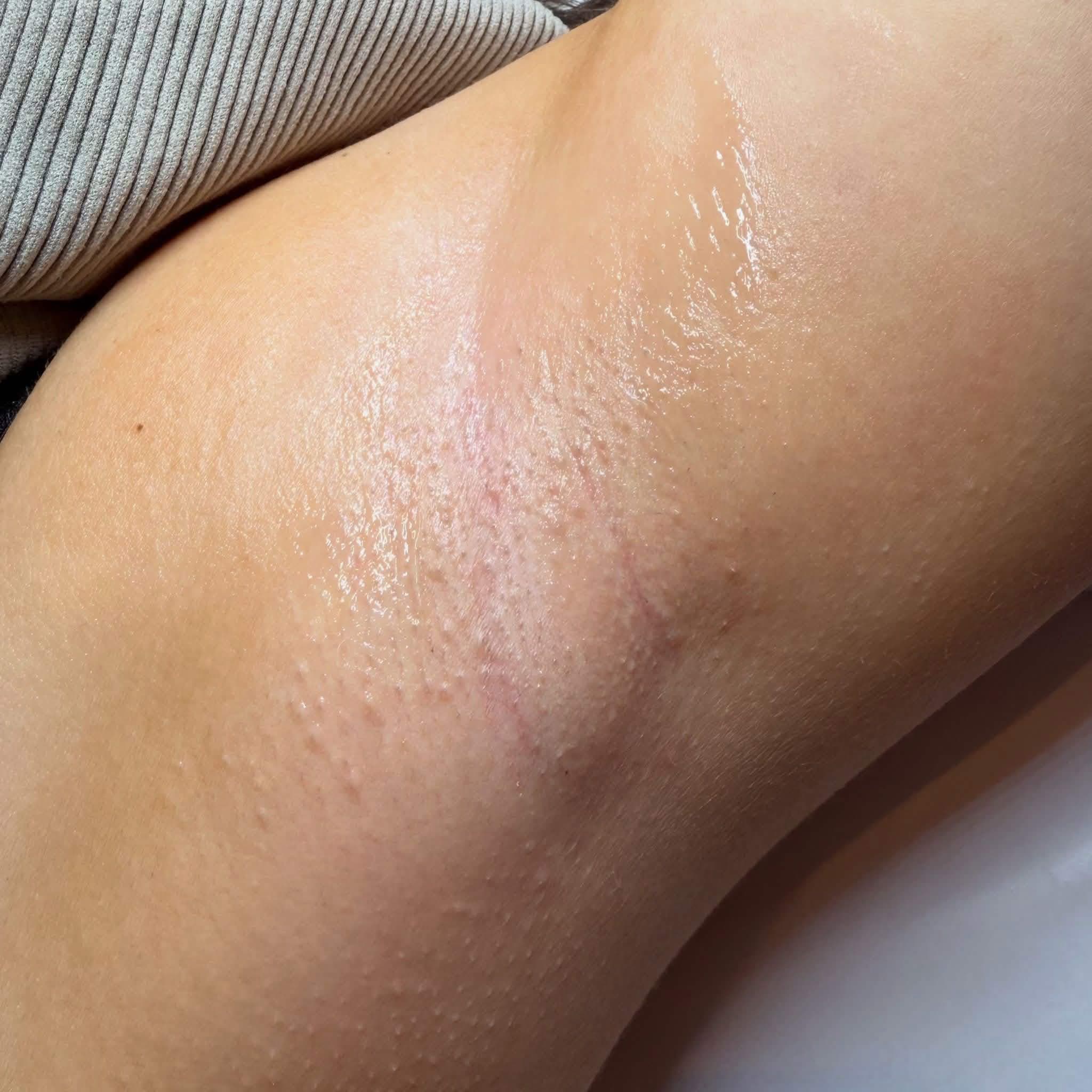 Close-up of underarm skin after laser hair removal treatments