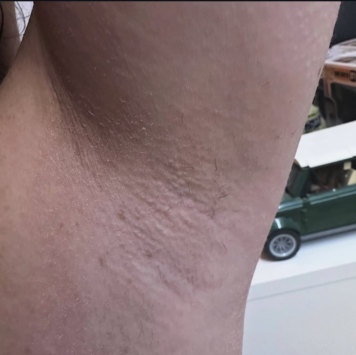 After laser hair removal treatment