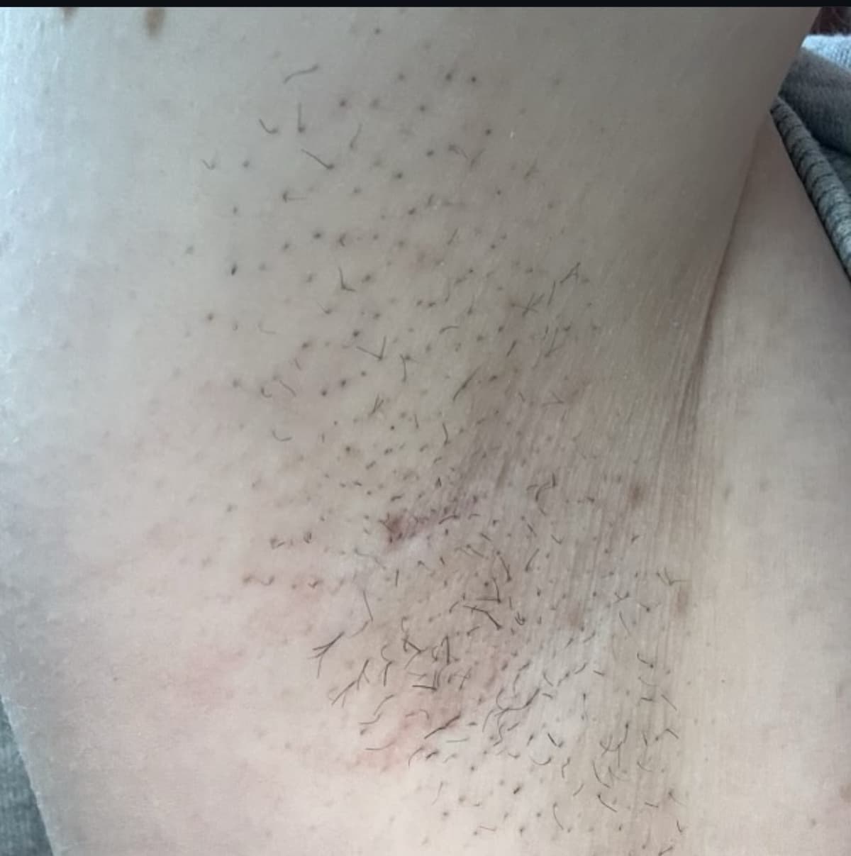 Before laser hair removal treatment
