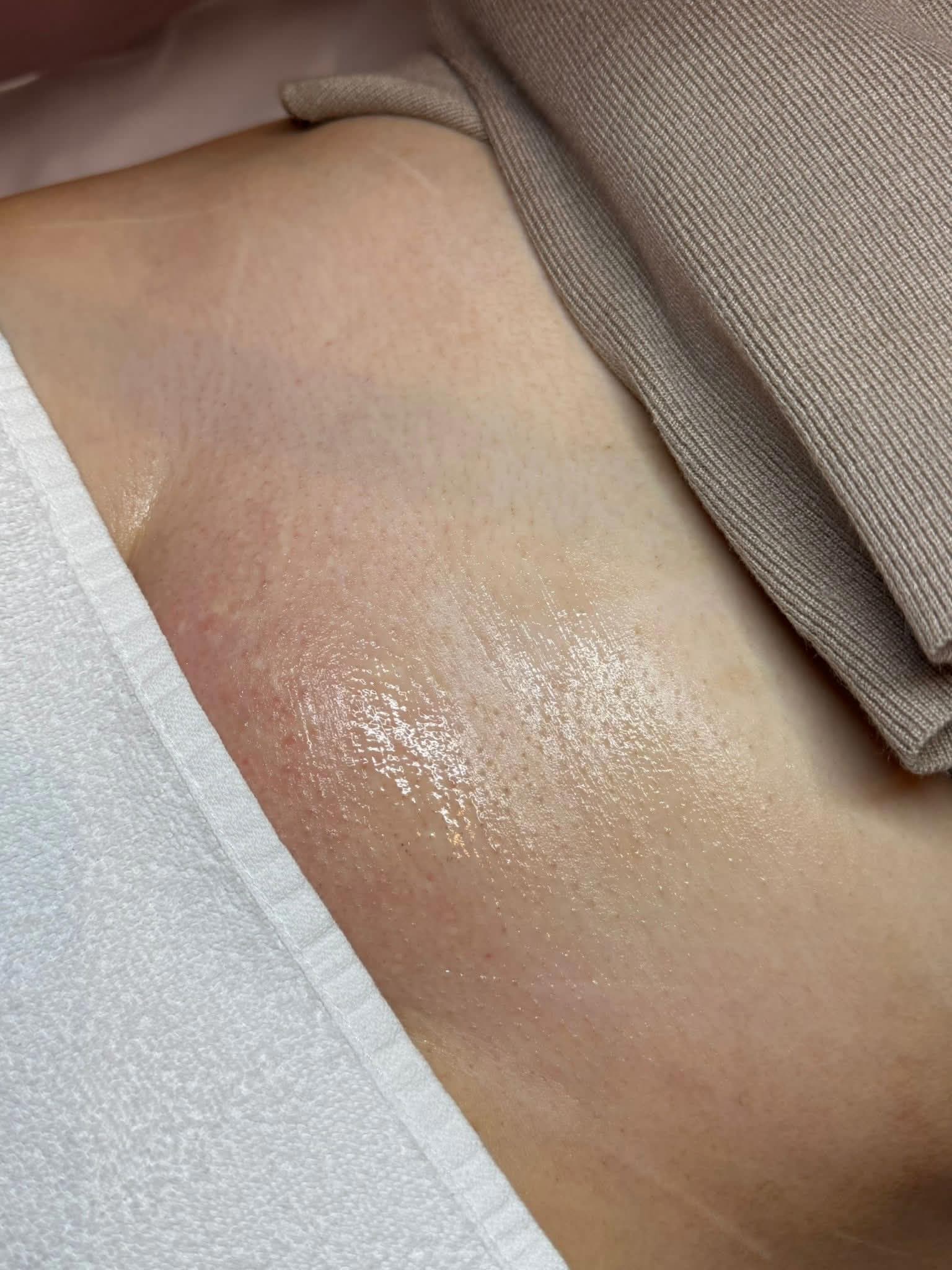 Underarm close-up after laser hair removal treatments