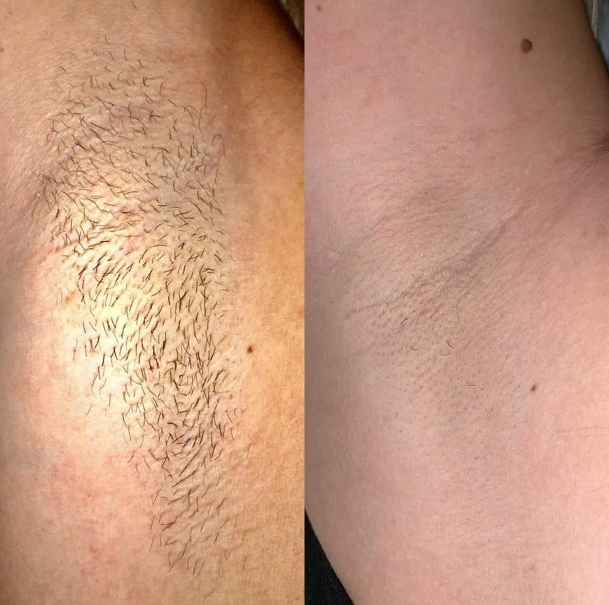 Before and after laser hair removal treatment showing significant hair reduction
